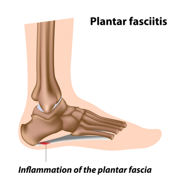 plantar fascitis