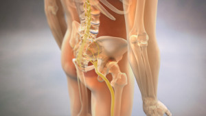 Chiropractic treatment of sciatica